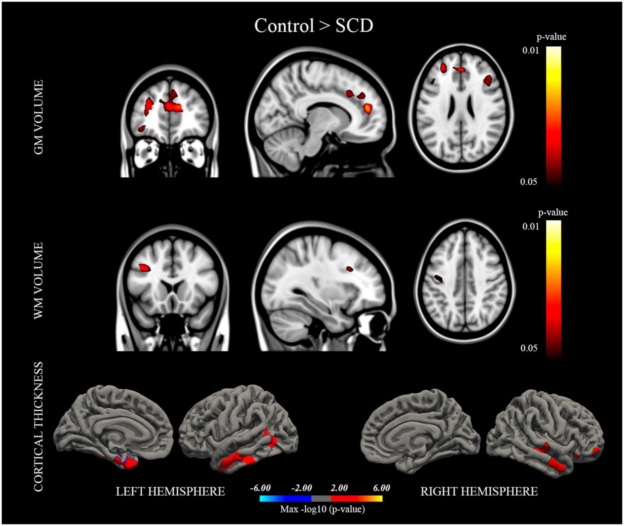 Neuroanatomical and neurocognitive changes associated with subjective cognitive decline